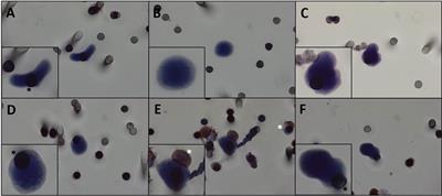 Circulating Tumor Cells in Desmoid Tumors: New Perspectives